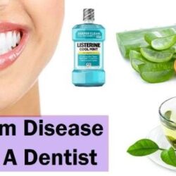 How to cure gum disease without a dentist